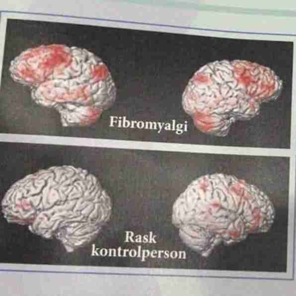 Fibromyalgi gruppe 